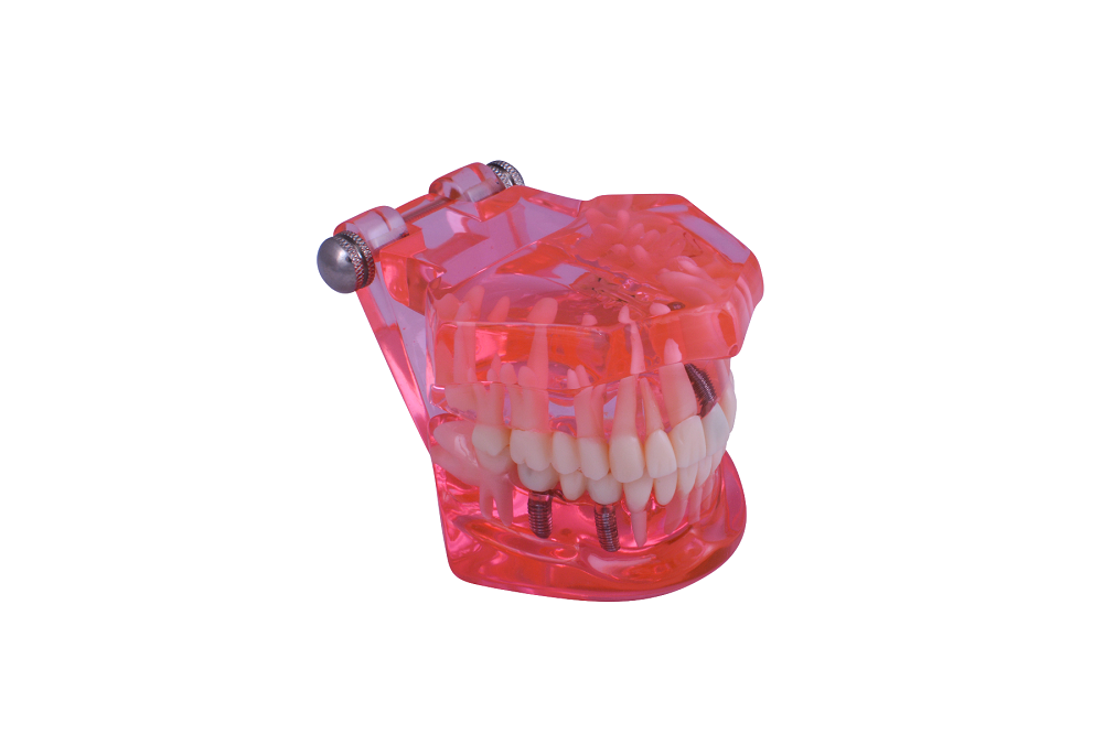 3D Dental Educational Restoration Model w/ Implant Ea