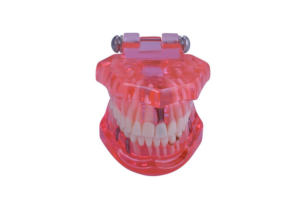 3D Dental Educational Restoration Model w/ Implant Ea